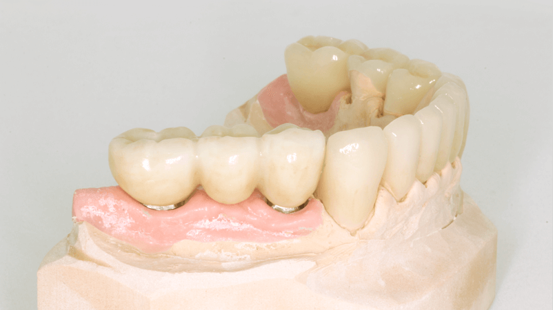 Восстановление зубов мостовидными протезами